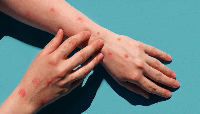 Monkeypox Hits Sindh: First confirmed case reported in Karachi