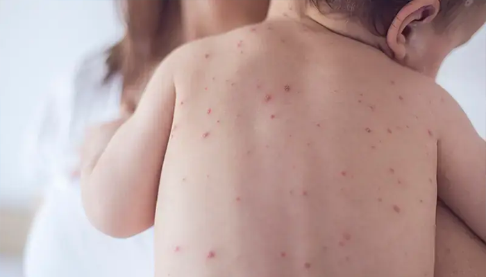 Measles outbreak in Sindh claims 40 child lives